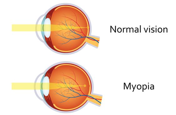 Myopia, Nearsightedness: Causes, Symptoms and Treatment